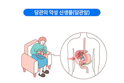 담관암